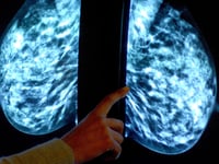 Breast screening uptake in Devon remains below pre-pandemic levels