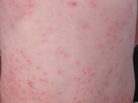 Parents urged to check child vaccinations amid fear of measles surge