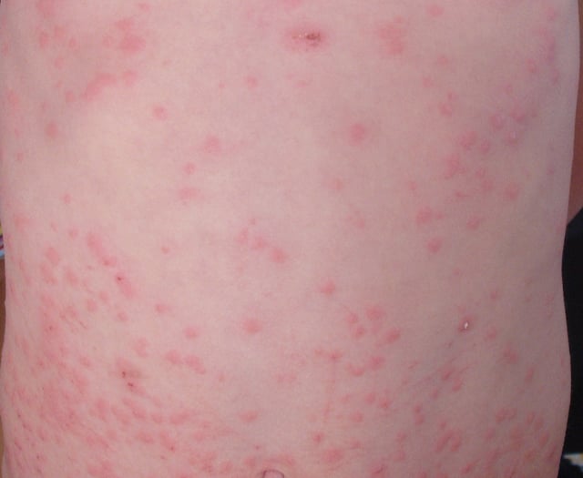 Parents urged to check child vaccinations amid fear of measles surge