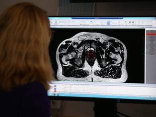 More men diagnosed with prostate cancer in Devon