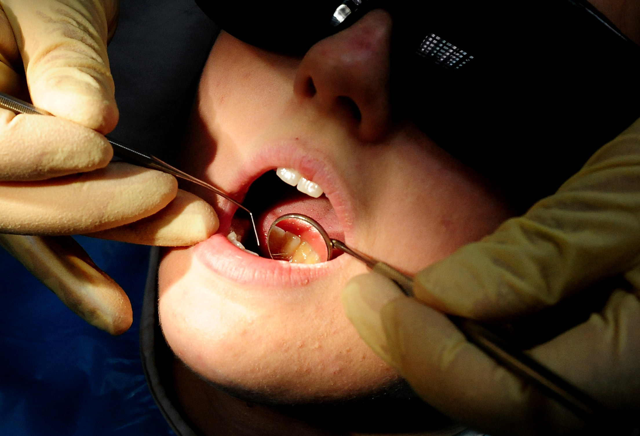 More than a quarter of children have rotting teeth in Teignbridge