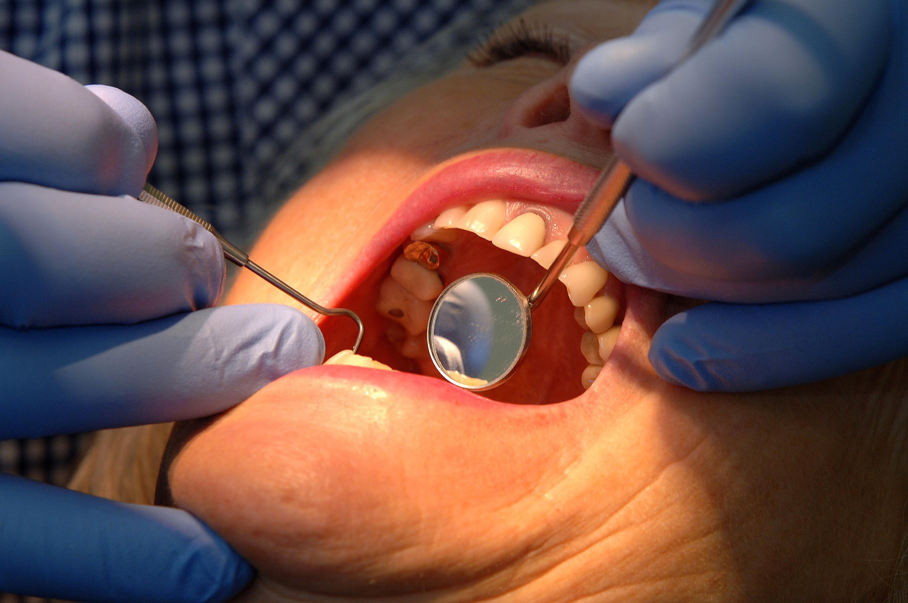  People in Devon more likely to have access to an NHS dentist – as 'postcode lottery' sees thousands miss out